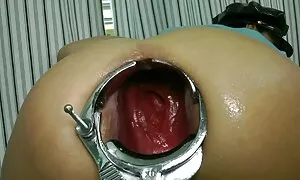 speculum prolapse nd ...